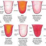 tongue-diagnosis